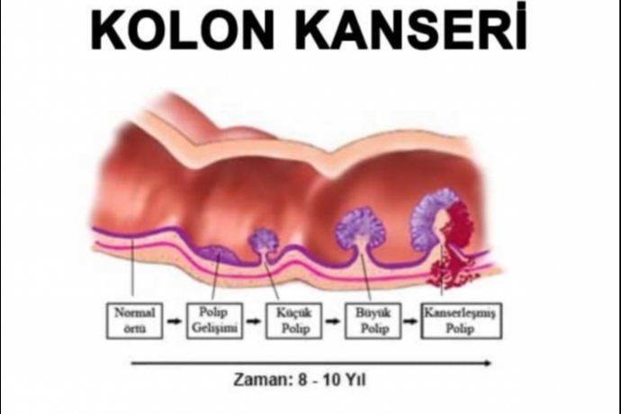 Kolon Kanseri Tehlikesi Göz Açtırmıyor: Erken Teşhis Hayat Kurtarıyor